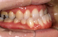 下顎前突の症例１
