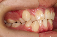 乱ぐい歯の症例３