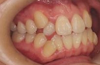 乱ぐい歯の症例４